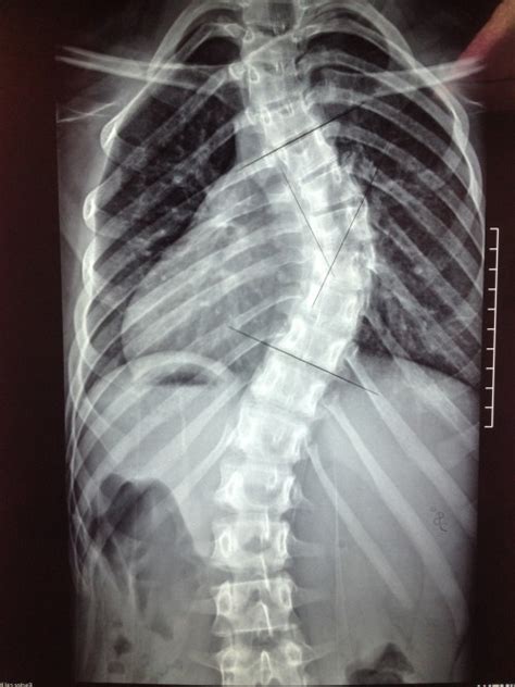 Bolet N Escoliosis En Ni Os Y Adolescentes Dr Aurelio Martinez