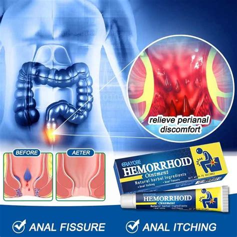 Hemorrhoid Ointment Relieve Hemorrhoid Pain Anal Bleeding Swelling Natural External Herbal