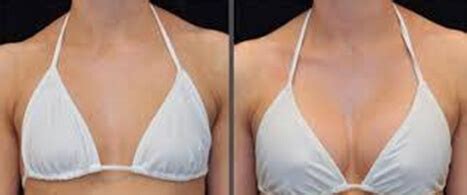 Chirurgie Esthetique Des Seins En Tunisie Photos Avant Apr S