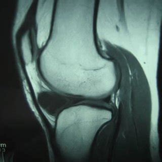 Mri Showed A Multilobular Cyst In The Infrapatellar Fat Pad With T Low