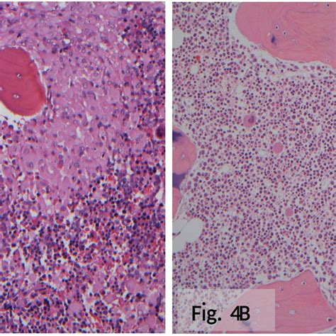 Bone Marrow Biopsy Under Low Power Field A Before And B After The