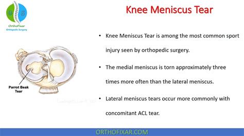 Knee Meniscus Tear - Easy Explained | OrthoFixar 2024