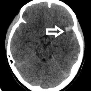 Computed Tomography Ct Brain Showing Left Temporal Contusion