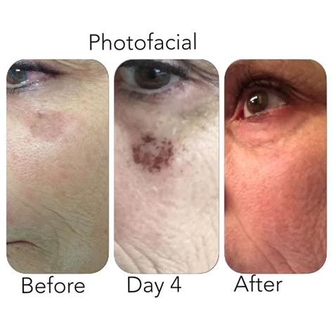 Photo Facial Rejuvenation And Treatment Of Dyschromia Before And