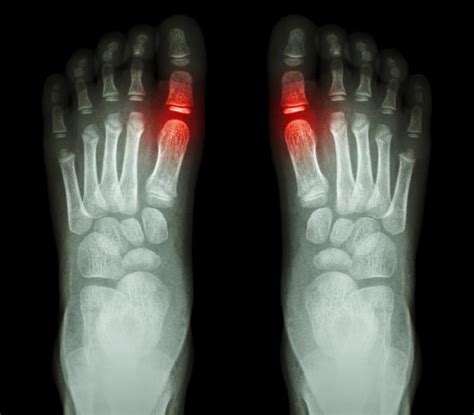 toe length meaning discover   toe lengths