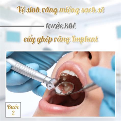 Quy trình cấy ghép răng Implant chuẩn y khoa tại Nha khoa Việt Đức