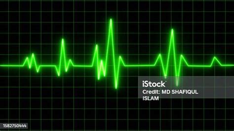 Electrocardiogram Show Pattern Heart Attack Ischemic Coronary Artery