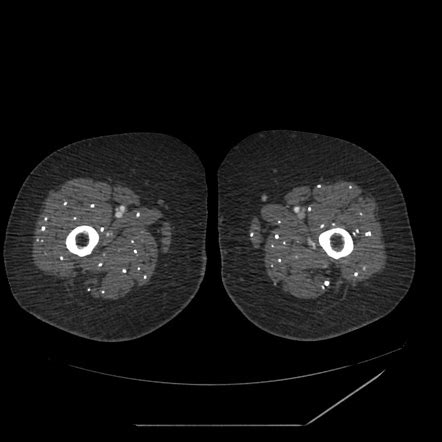 Cysticercosis Radiology Reference Article Radiopaedia Org