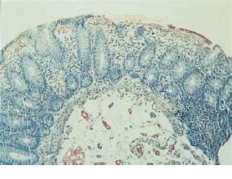 Figure 1823 From Histopathology Of Crohn S Disease And Ulcerative Colitis Semantic Scholar