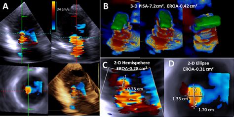 Figure 1 From Quantification Of Chronic Functional Mitral Regurgitation