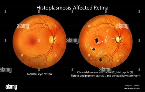 Illustration Of A Retina Affected By Presumed Ocular Histoplasmosis