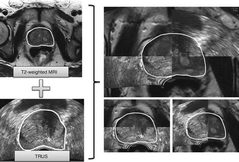 Mri Ultrasound Fusion Imaging Radiology Key