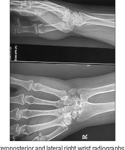 Figure 1 From Concomitant Avascular Necrosis Of The Lunate And Proximal