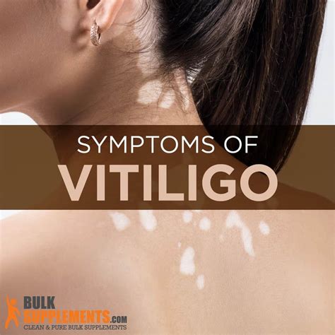 Vitiligo: Symptoms, Causes & Treatment