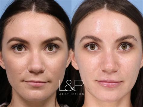 Microneedling Before And After Landp Aesthetics