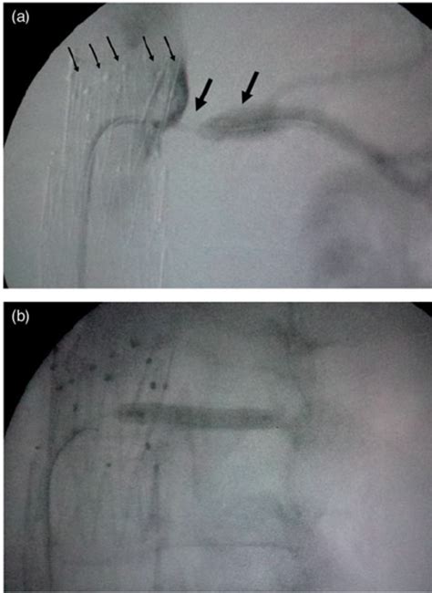 A Intraoperative Selective Left Renal Angiography Showing Stenosis At