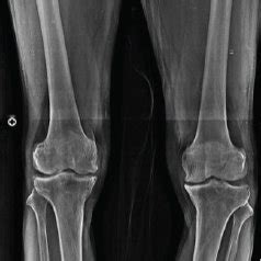 A An Anteroposterior Ap Radiograph Of A Year Old Male Patient