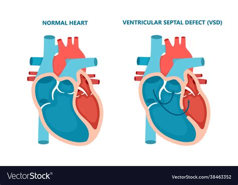 Ventricular Septal Defect Vsd Human Heart Muscle Vector Image