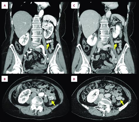 Contrast Enhanced Computed Tomography The Tumor Arrows Showed Strong