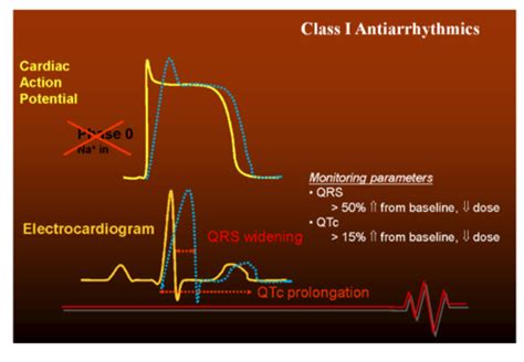 6 Arrhythmia Flashcards Quizlet