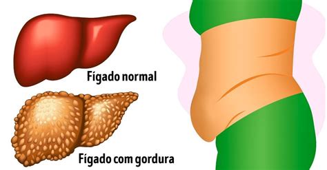 6 Sintomas de gordura no fígado para se alertar e buscar tratamento