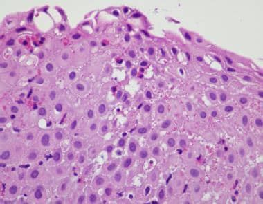 Eosinophilic Esophagitis Histology