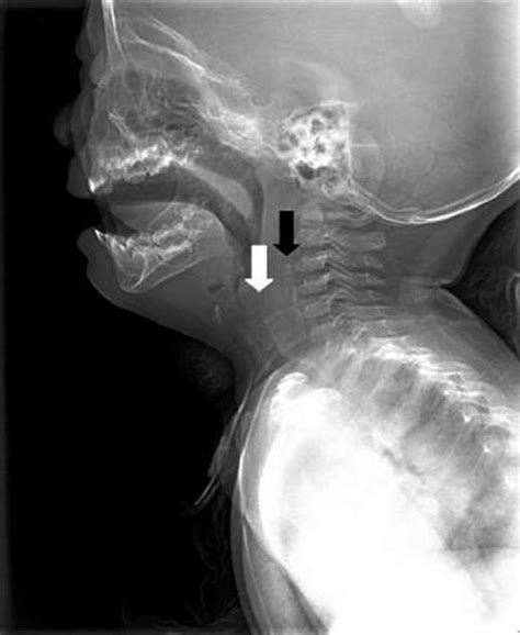 Soft Tissue Neck X Ray