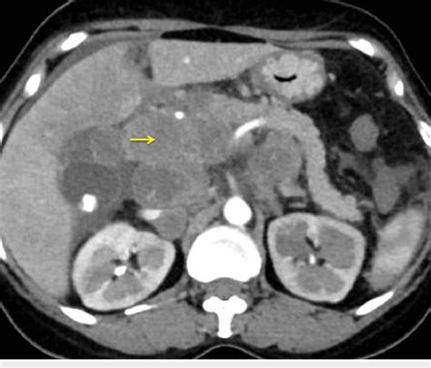 CT Of The Abdomen Showing Conglomerated Lymph Nodal Mass Near The