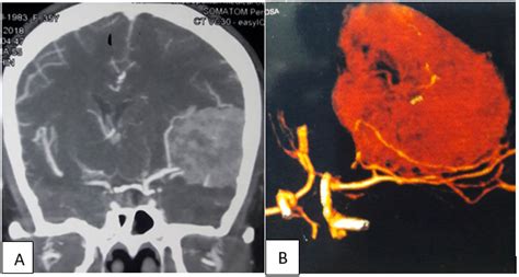 Ct Angiogram Of Cerebral Vessels A With 3d Reconstruction Arteriogram