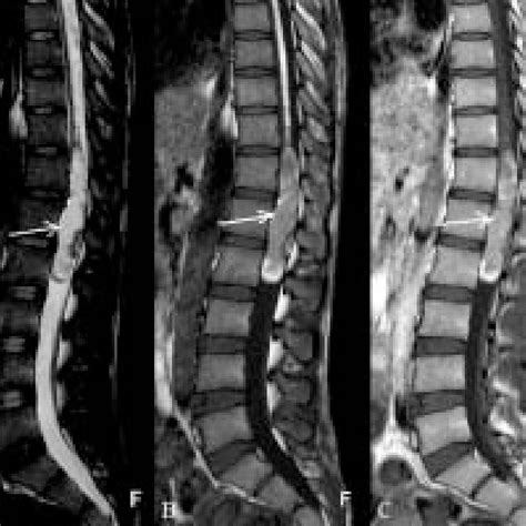 A C Sagittal T2w A And T1w B Mri Images Show A Heterogeneous