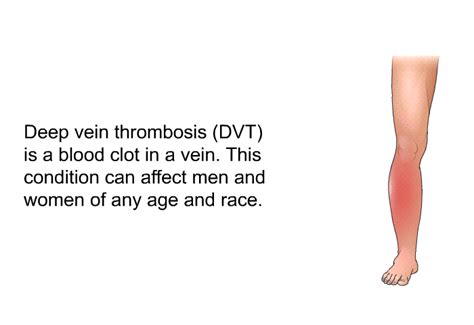 Deep Vein Thrombosis