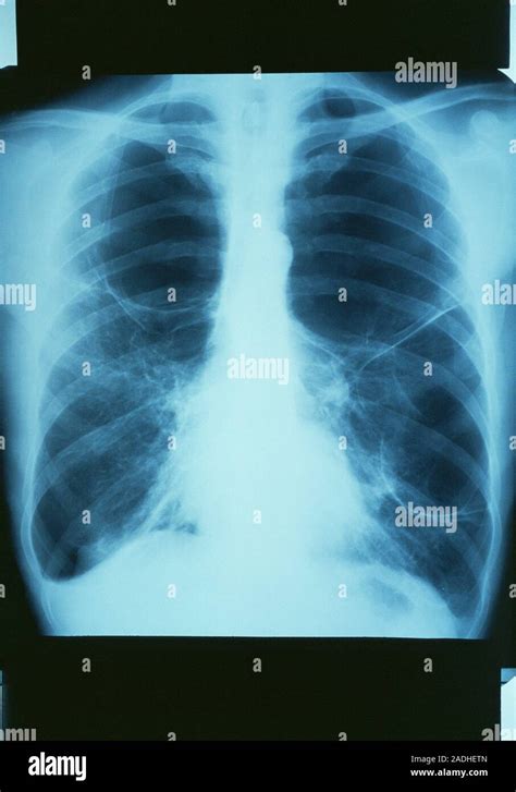 El Enfisema Radiografía De Tórax De Un Paciente Con Enfisema Bulloso