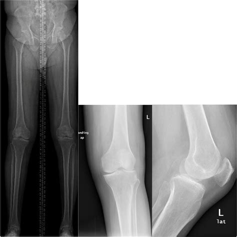 Anteroposterior And Lateral Views Of Both Knees And Long Film View Download Scientific Diagram