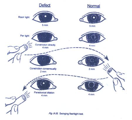 pupillary reflex - DriverLayer Search Engine