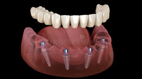 Prótese Mandibular Em 4 Sistemas Apoiados Por Implantes Animação 3d