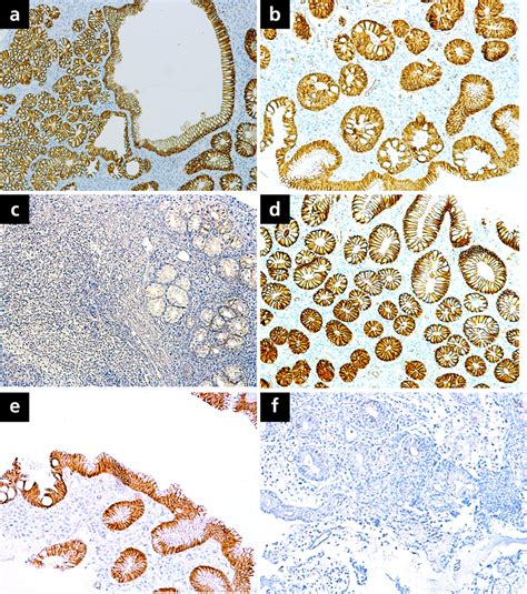 Immunohistochemical Staining Of E Cadherin And β Catenin Dab A Download Scientific Diagram