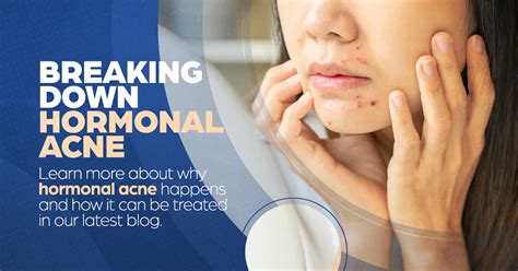 The Breakout Battle Understanding Hormonal Acne Alamo Heights