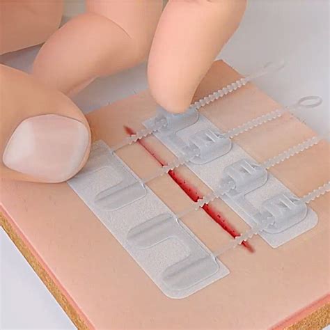 Zip Stitch | Easy Wound Closure Strips | No-More Stitches and ...