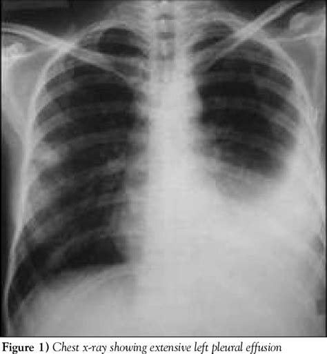 Figure From Pneumonia And Pleural Effusion Due To Cryptococcus