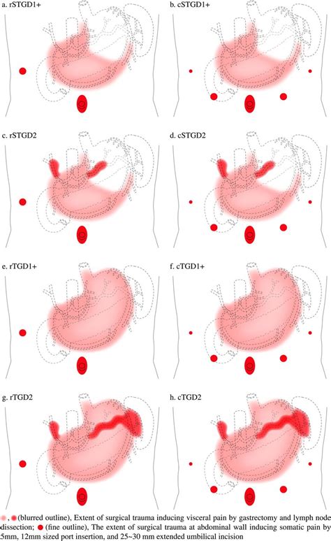 Schematic Illustration Of Surgical Trauma Following Reduced Port