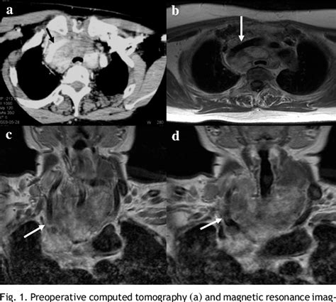 Figure From Treatment Of Locally Advanced Thyroid Cancer Invading The