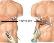 Cirurgia na Vesícula Pedras Saúde Cultura Mix