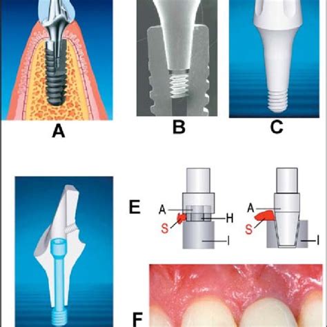 A Balance Posterior Abutments On Master Laboratory Cast Positioned Download Scientific