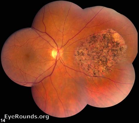 Atlas Entry Retinitis Pigmentosa RP