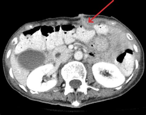 Contrast Enhanced Abdominal Computed Tomography Revealing The