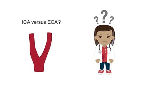 Distinguishing the internal carotid artery (ICA) from the externa | Medmastery