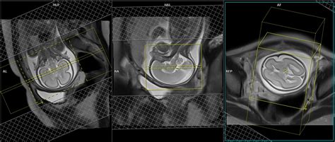 Fetal Brain MRI | Fetal Brain Scan Protocol and Planning