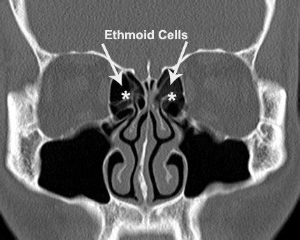 Why Do I Need A CT Scan For My Sinuses Dr Dharambir S Sethi