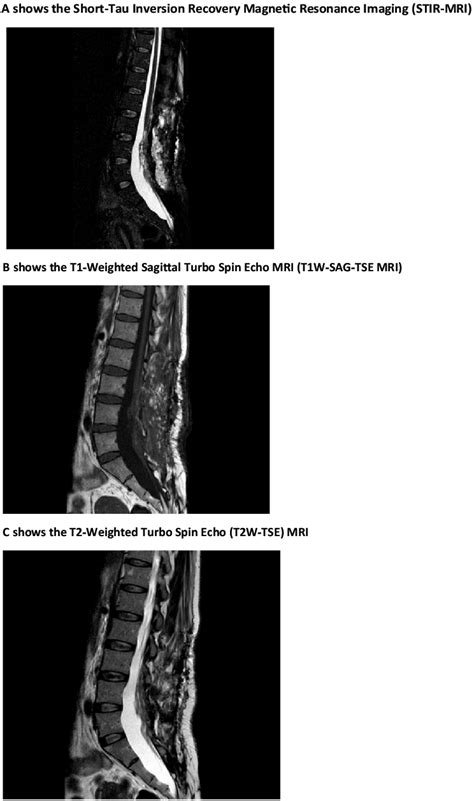 A Shows The Short Tau Inversion Recovery Magnetic Resonance Imaging