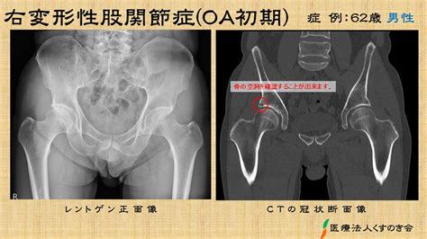 股関節が痛い 医療法人 くすのき会